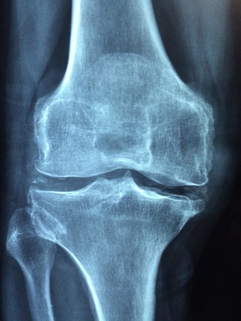 radiographie d'un genou atteint d'arthrose